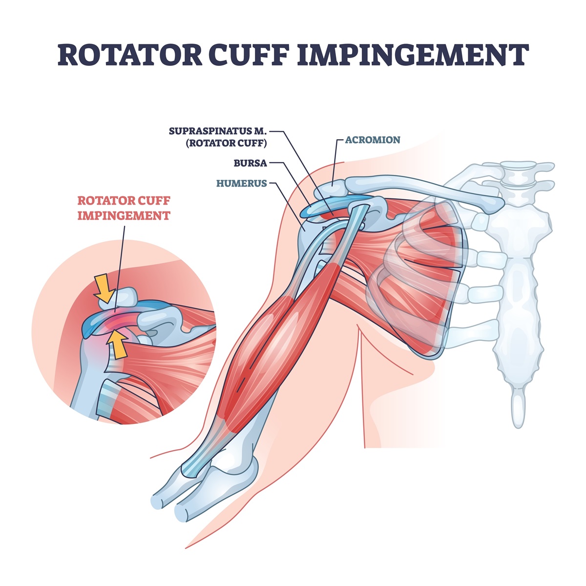 Rotátorová manžeta ramena a Impingement syndróm